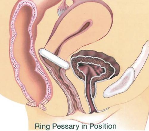 GYN&RING, prstencový pesar bez opory, velikost T2=57 mm, 1 ks