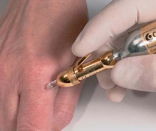 CRYOALFA LUX, univerzální přístroj pro dermatologické aplikace, s tryskou 1 mm