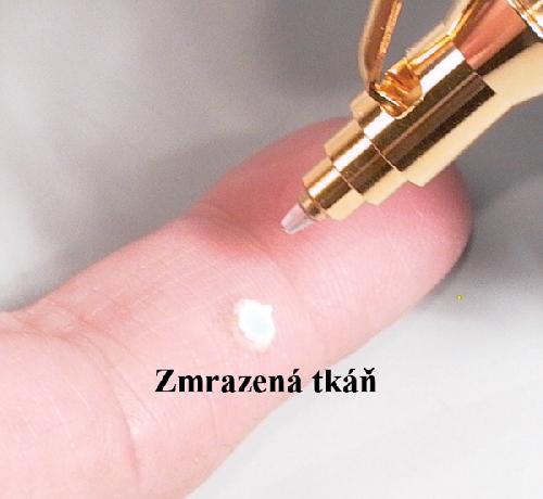 CRYOALFA SUPER TRYSKA, kryochirurgický přístroj, s tryskou, souprava s 1 lahvičkou N2O