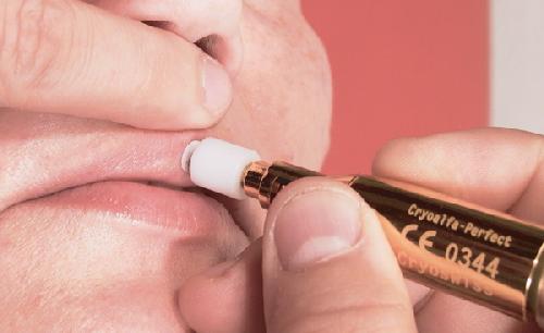 CRYOALFA SUPER KONTAKT, kryochirurgický přístroj, s kontaktním adaptérem, souprava s 1 lahvičkou N2O
