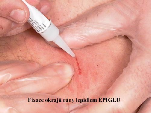 EPIGLU, tkáňové lepidlo, jedna dávka s 0,3 g