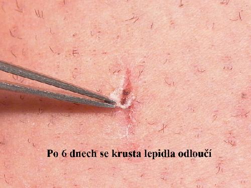 EPIGLU, tkáňové lepidlo, jedna dávka s 0,3 g