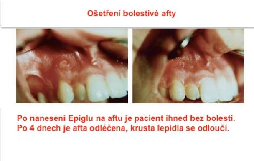 EPIGLU, tkáňové lepidlo, jedna dávka s 0,3 g