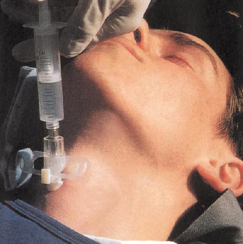 QUICK-TRACH, pro děti, průměr kanyly 2 mm